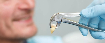 Tooth Extractions in Monument | Trusted Oral Surgeons